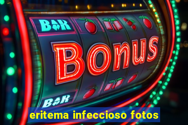 eritema infeccioso fotos